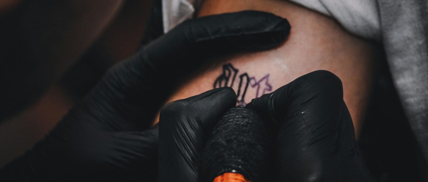 tattoo removal